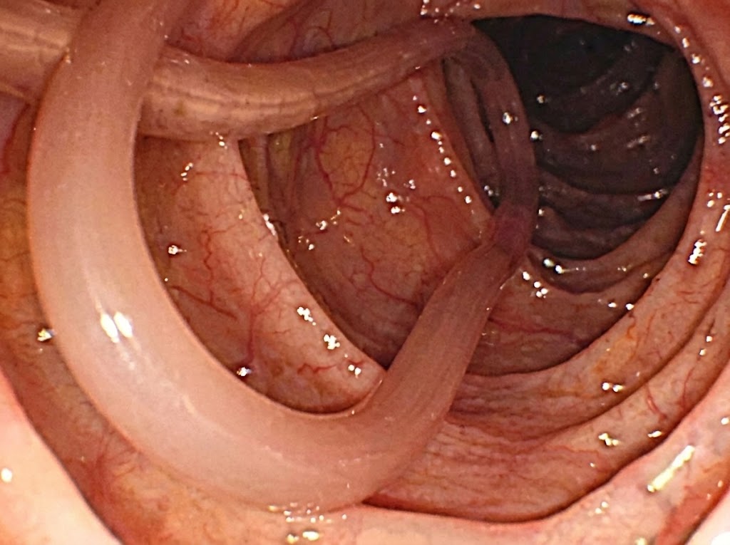 Ascaris lumbricoides